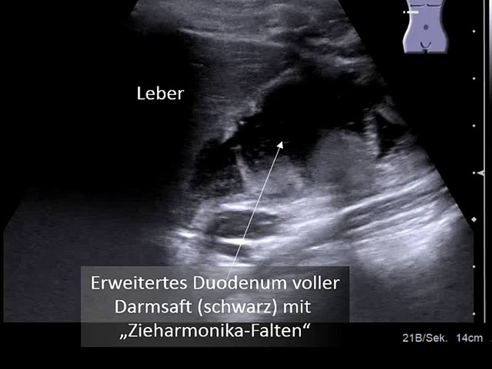 Erweitertes Duodenum mit Zieharmonikafalten