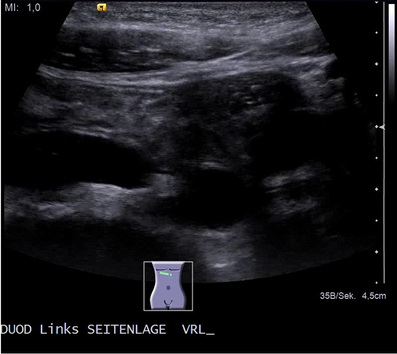 Wilkie Syndrom: Entleerung des Duodenums in Linksseitenlage