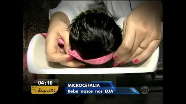 EUA confirmam primeiro caso de microcefalia associado ao zika vírus