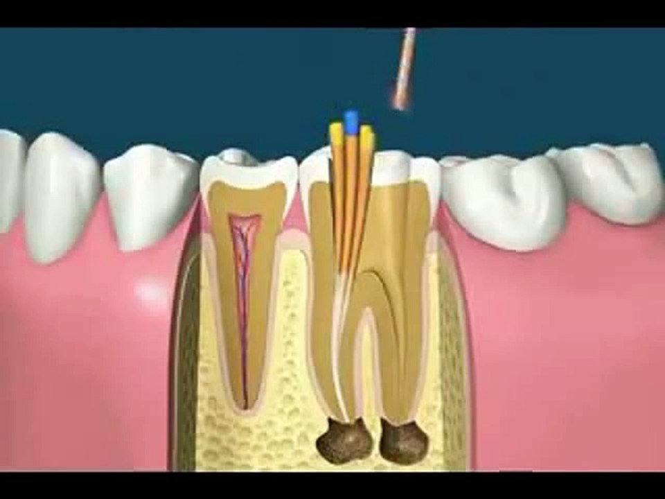 How Root Canal Treatment (RCT) Works