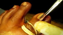 Toenail fungus treatment compilation video | Toenail lifting removal vol7