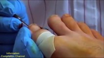 Toenail fungus treatment compilation video | Cracked toenail removal vol3