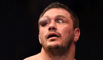 MMA: the large hematoma to the eye of Matt Mitrione