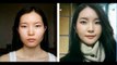 Korean Plastic Surgery Before And After Photos