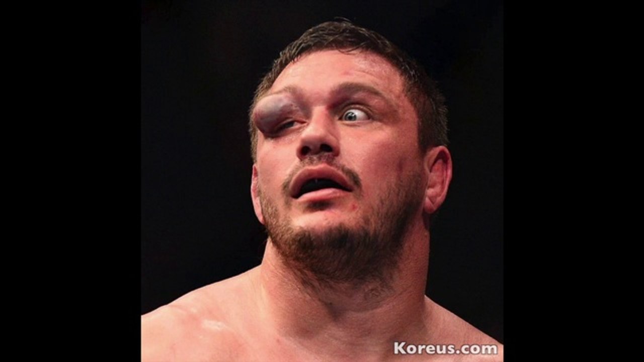 L'énorme hématome à l'oeil de Matt Mitrione - Combattant MMA