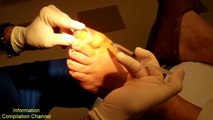 Toenail fungus treatment compilation video | Ugly toenaill removal vol6
