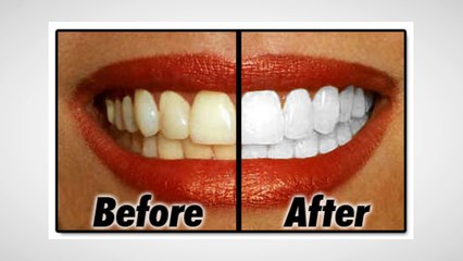 Comment Blanchir Ses Dents Rapidement - Obtenez Votre Echantillon Gratuit