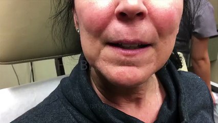 Blackhead-