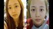 Korean Plastic Surgery Extreme Change before and after 02 ศัลยศาสตร์ v shape