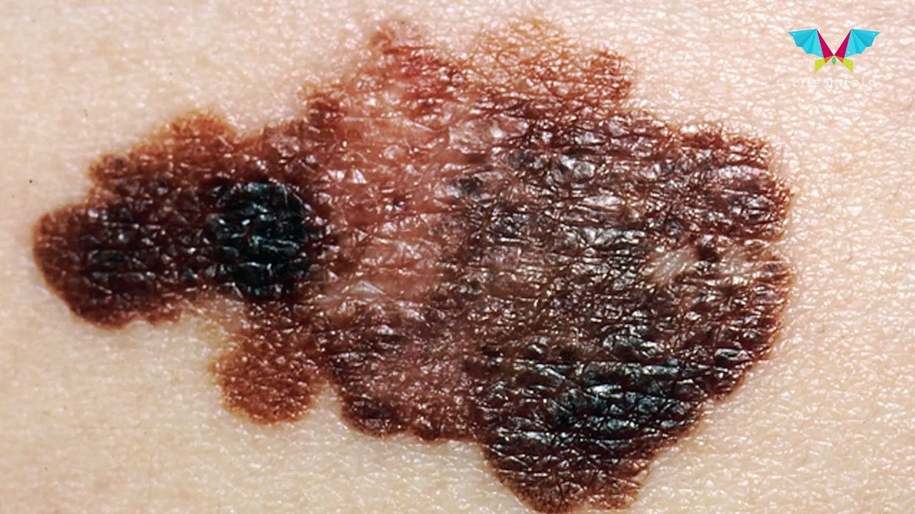 The Scary Melanoma