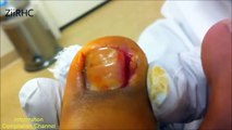 Toenail fungus treatment compilation video | Torn toenail removal vol1