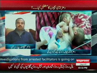 senior pediatric surgeon expert opinion about conjoined twins
