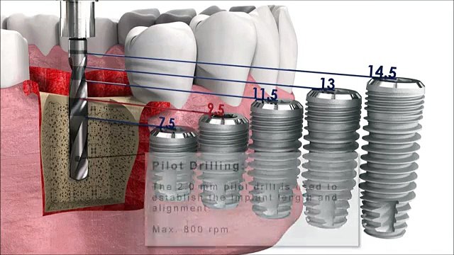 Dental Implant Surgery Animation _ implant insertion