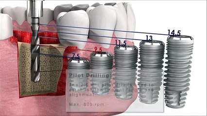 Dental Implant Surgery Animation _ implant insertion