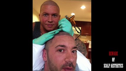 My Horror story with full head Laser removal Scalp Aesthetic SMP (www.scalp-aesthetics.com and www.scalpaacademy.com)