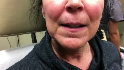 Elle se fait retirer un point noir monstrueux logé dans sa lèvre supérieure