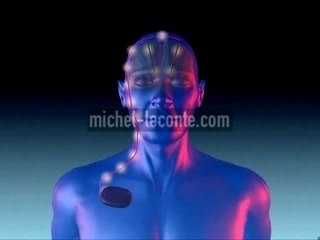 PARKINSON - DEEP BRAIN STIMULATION - DBS - EPILEPSY