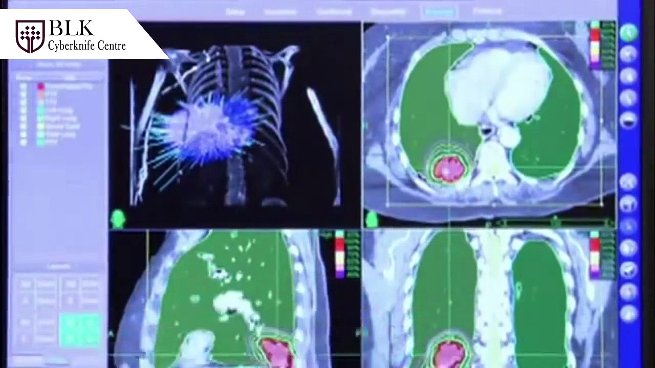 CyberKnife Benefits for Radiation Oncologists