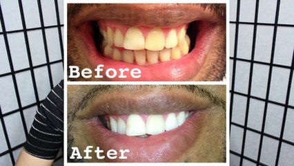 How to whiten EXTREMELY yellow teeth at home (with actual pictures)