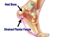 Heel Pain (Plantar Fasciitis) Treatment in Largo, FL