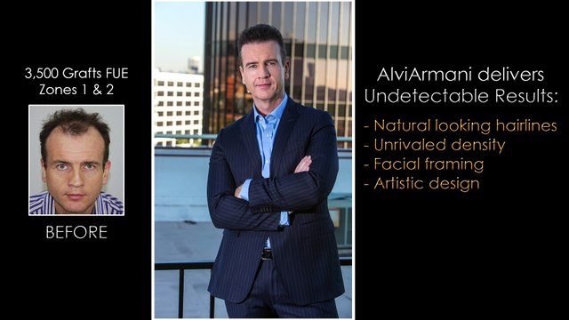 Best Hair Transplant Results – alviarmani clinic