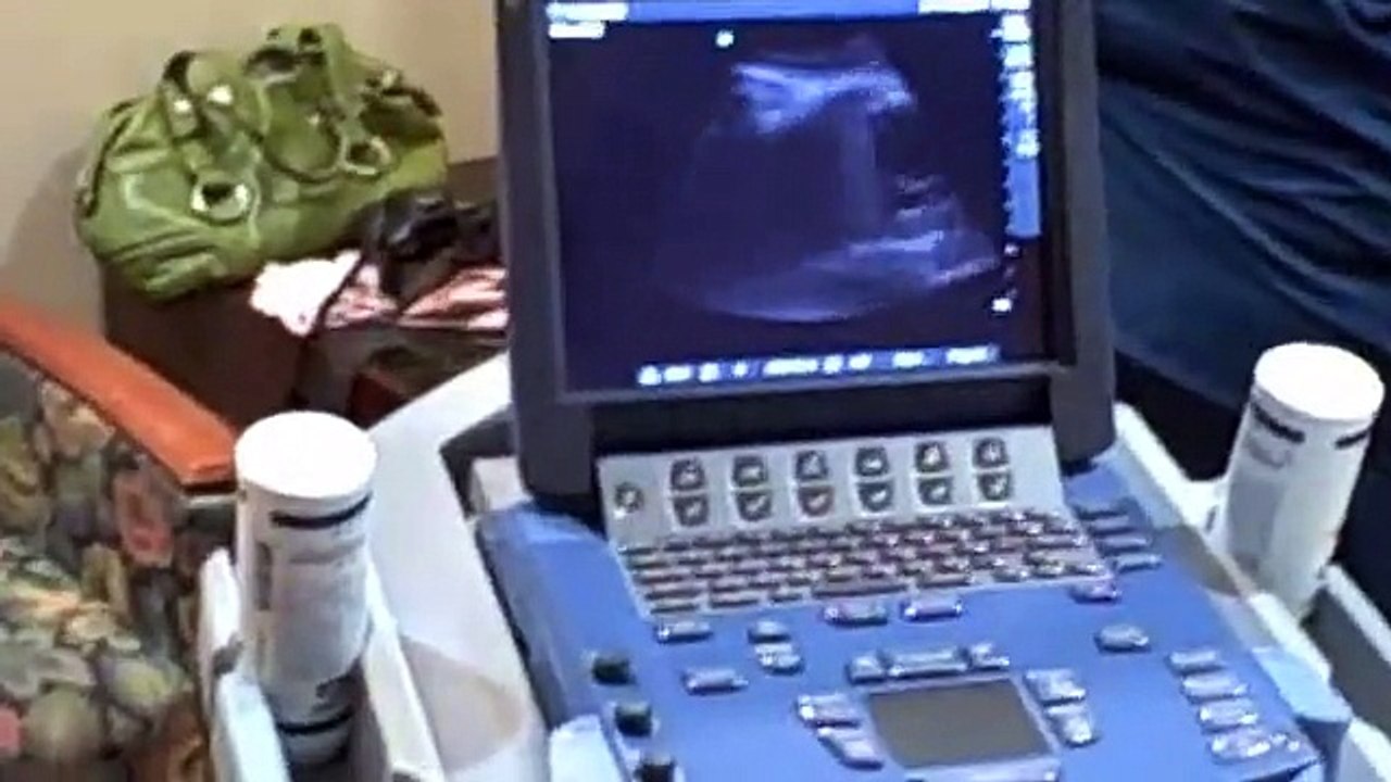 External Cephelic Version Procedure on a Breech Baby