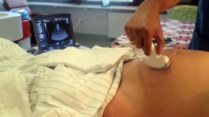 Motivated mother avoids Caesarean. Painless ECV for Breech. Äußere Wendung