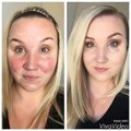 How to cover up acne, acne scars, rosacea and imperfections with naturally based makeup.