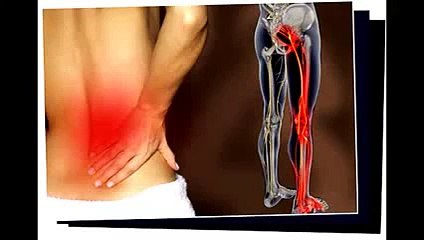 Sciatica SOS Program + Bonuses Review