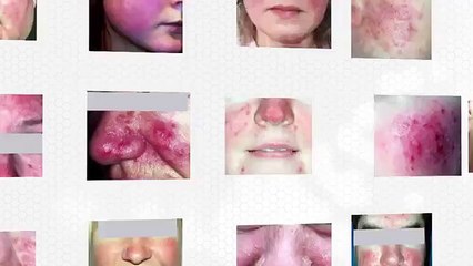 Laser Treatment for Rosacea