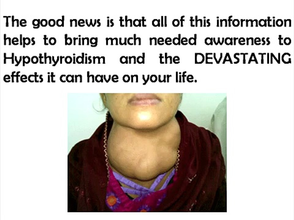 The Hypothyroidism Revolution – Your Guide For Hypothyroidism Natural Treatment