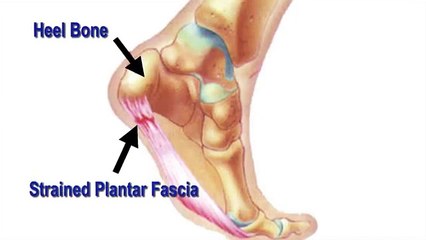 Plantar Fasciitis - Briarwood, Flushing, Queens, Melville - Podiatrist Geoffrey Epstein