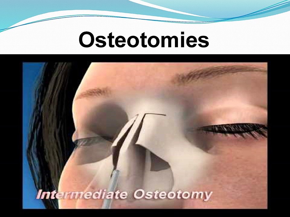 Improving the Shape of the Nasal using Rhinoplasty by Dr Nedra Dodds