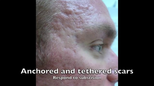 Plastic Surgery of Face Acne Scars (Laser Treatment)