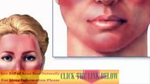 Rosacea Treatment  - Best Acne Treatments - Acne Scar Removal