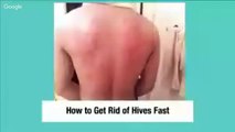 How to Get Rid of Hives Fast - Get Rid of Hives Fast & Permanently