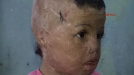 Batman - Kalıcı Makyajla Kaş Yapılan Suriyeli Evin'e Yüz Nakli Yapılacak