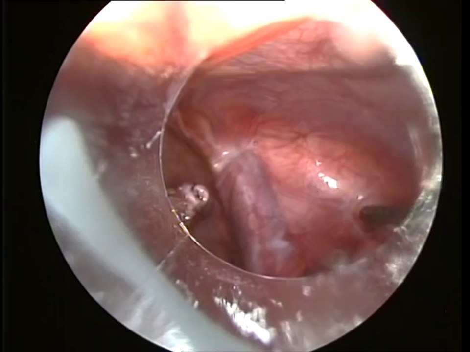 Appendix Operation