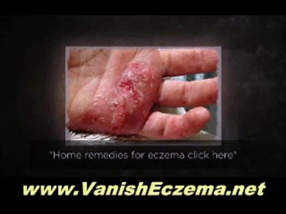 How to Eliminate Dry Skin, Eczema, Psoriasis and Rosacea Using Quality Face Creams