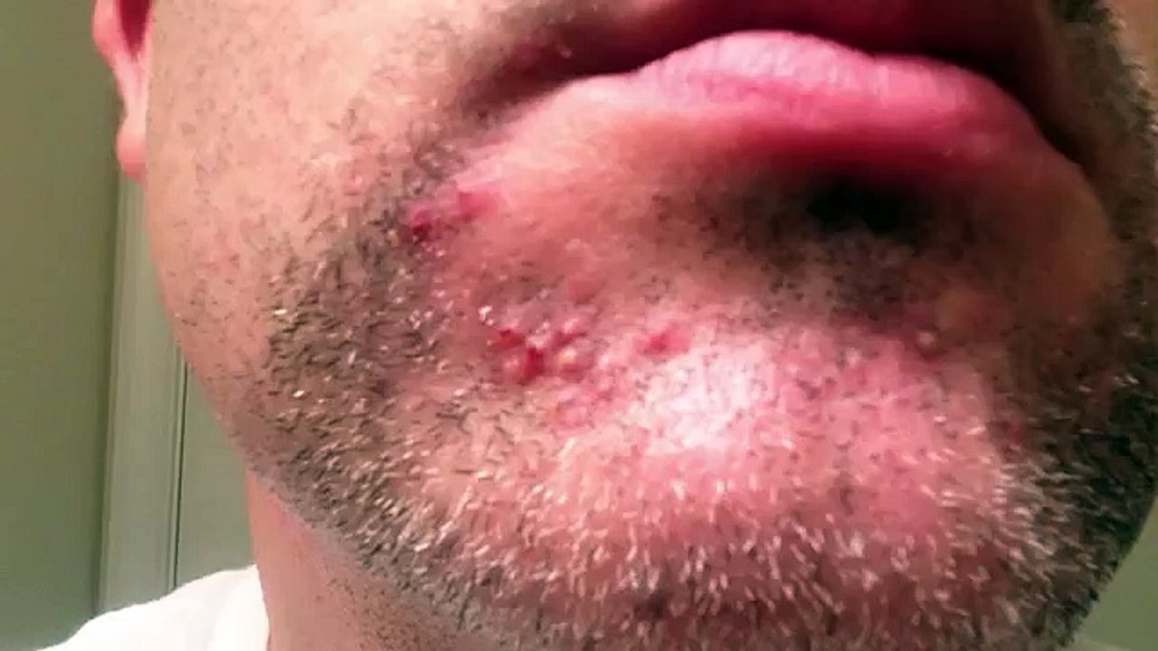 Rosacea Presentation