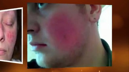 El Acné Rosacea - Eliminalo De Raíz