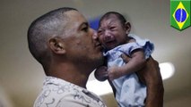 What is microcephaly, the rare birth defect linked to the Zika virus?