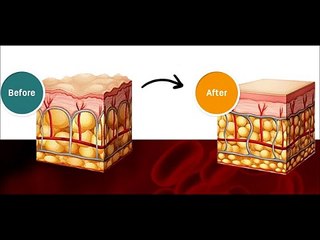 Cellulite Factor Solution Review BY Dr  Charles