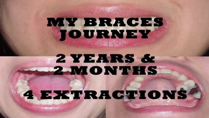 Adult Braces Journey Before and After Time Lapse Photos