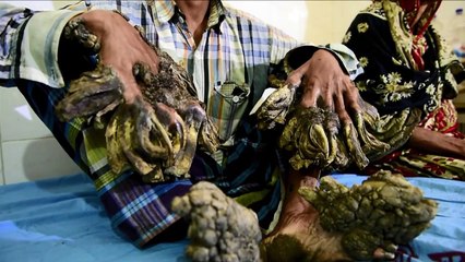 Bangladesh: un "homme-arbre" opéré de ses excroissances