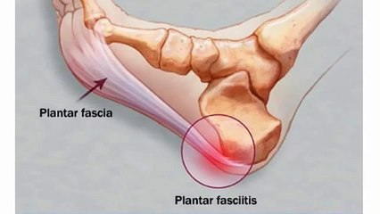 Plantar Fasciitis Treatment