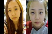 Koreanische Plastische Chirurgie Extreme Veränderung vor und nach 02 ศัลยศาสตร์ v-Form