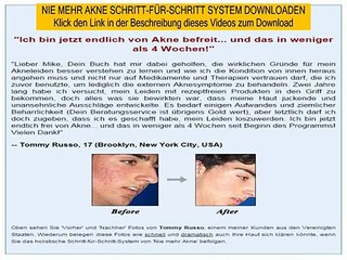 ursache von akne bekämpfen - nie mehr akne miniprogramm