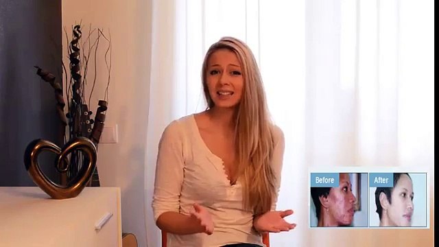 Acne No More Get Rid of Acne Home Remedies That Works