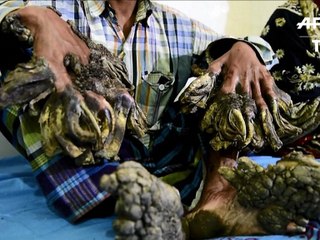 Bangladesh: un "homme-arbre" aux excroissances impressionnantes opéré
